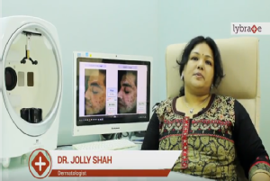 Causes and cosmetic treatment for Acne scars<br/><br/>Hello! I am Dr. Jolly Shah practicing Derma...
