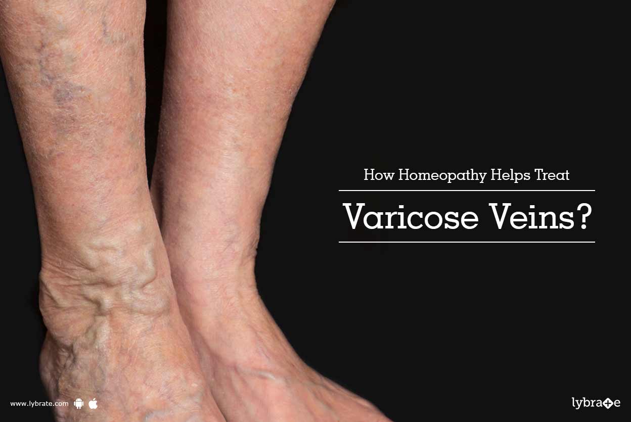 How to treat inflammation and varicose veins How to treat inflammation and varicose veins