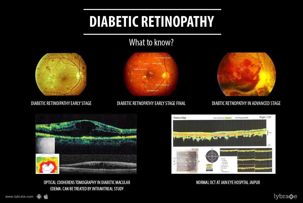 diabetic retinopathy diabetic retinopathy