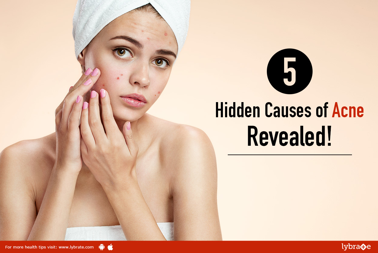 acne pimples causes treatment acne pimples causes treatment