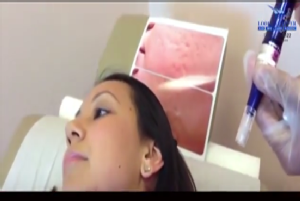 How treatment is carried out with dermapen-collagen induction therapy.<br/>